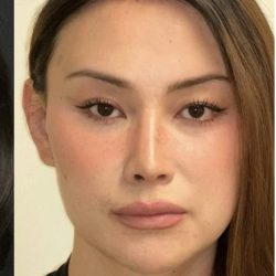 Facial Feminization Before & After Patient #2204