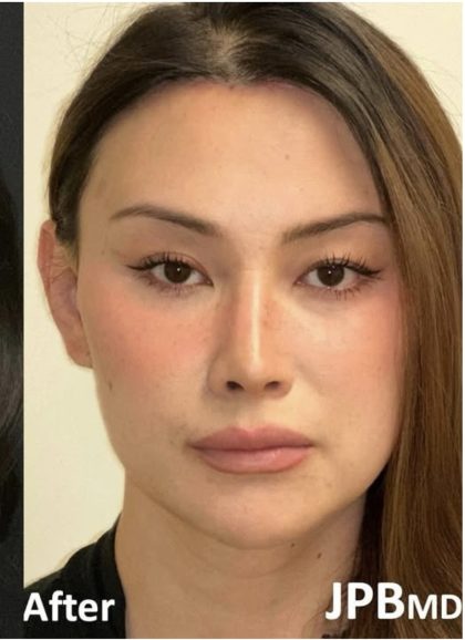 Facial Feminization Before & After Patient #2204