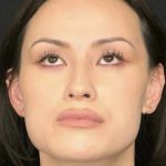 Facial Feminization Before & After Patient #2204