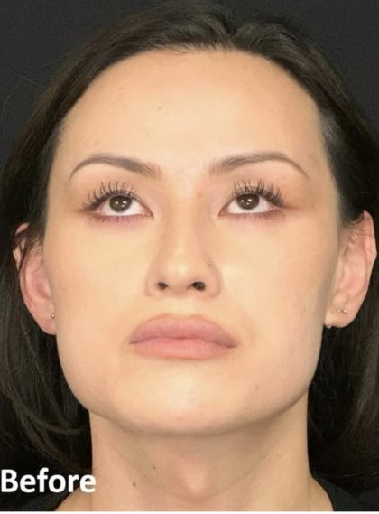 Facial Feminization Before & After Patient #2204