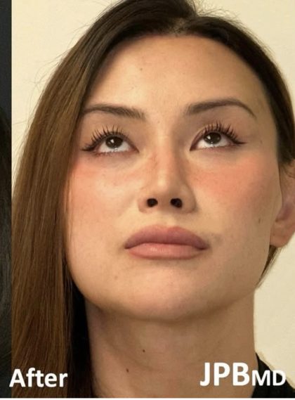 Facial Feminization Before & After Patient #2204
