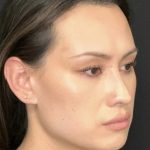 Facial Feminization Before & After Patient #2204