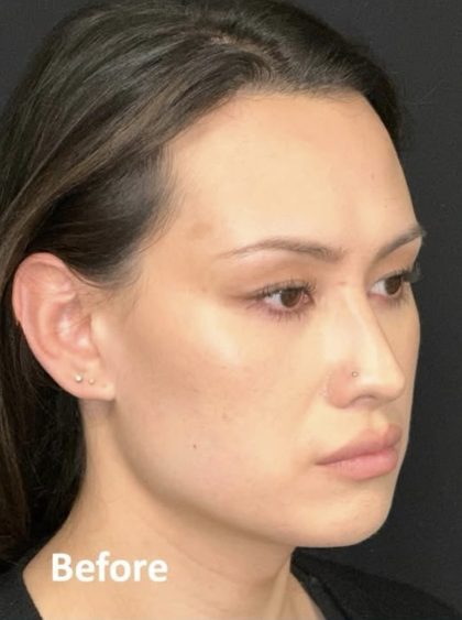 Facial Feminization Before & After Patient #2204