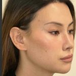 Facial Feminization Before & After Patient #2204