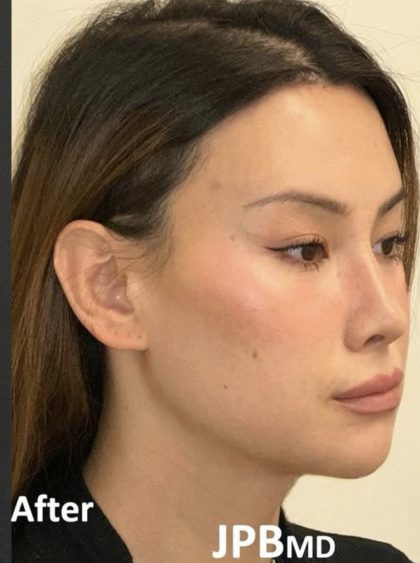 Facial Feminization Before & After Patient #2204