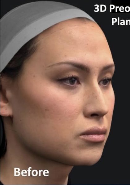 Facial Feminization Before & After Patient #2204