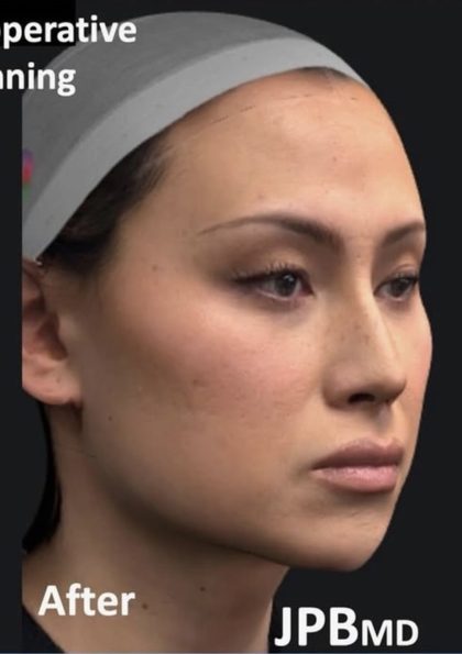 Facial Feminization Before & After Patient #2204
