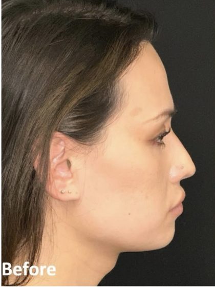 Facial Feminization Before & After Patient #2204