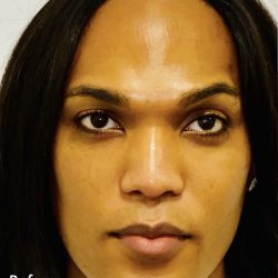 Facial Feminization Before & After Patient #2193