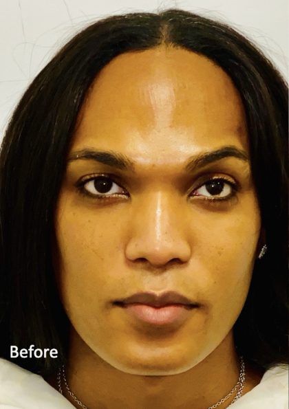 Facial Feminization Before & After Patient #2193