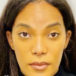 Facial Feminization Before & After Patient #2193