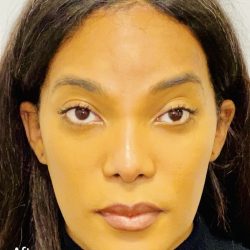 Facial Feminization Before & After Patient #2193