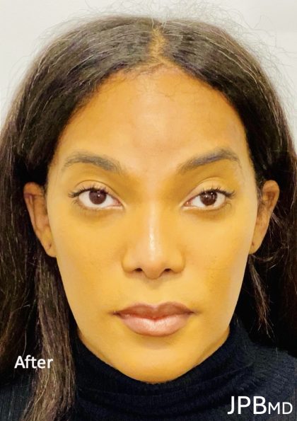 Facial Feminization Before & After Patient #2193