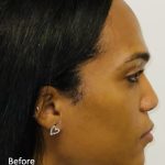 Facial Feminization Before & After Patient #2193