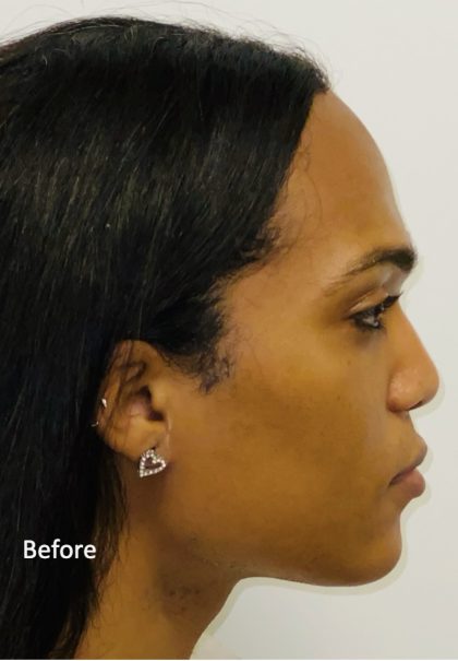Facial Feminization Before & After Patient #2193