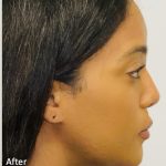 Facial Feminization Before & After Patient #2193