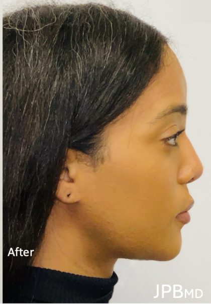 Facial Feminization Before & After Patient #2193