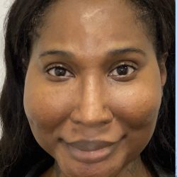 Facial Feminization Before & After Patient #2205