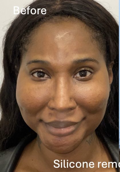 Facial Feminization Before & After Patient #2205