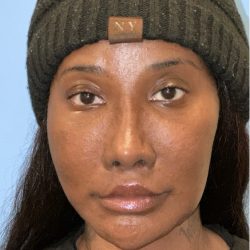 Facial Feminization Before & After Patient #2205