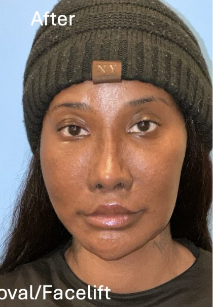 Facial Feminization Before & After Patient #2205