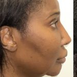 Facial Feminization Before & After Patient #2205