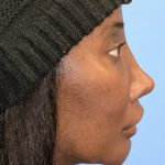 Facial Feminization Before & After Patient #2205