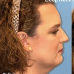 Facial Feminization Before & After Patient #2206