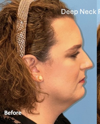 Facial Feminization Before & After Patient #2206