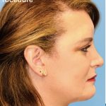 Facial Feminization Before & After Patient #2206