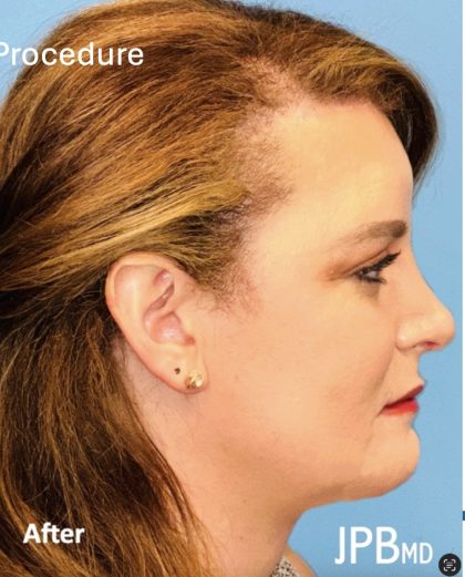 Facial Feminization Before & After Patient #2206