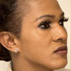 Facial Feminization Before & After Patient #2207