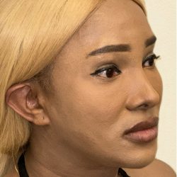 Facial Feminization Before & After Patient #2207