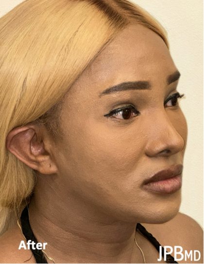 Facial Feminization Before & After Patient #2207