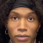 Facial Feminization Before & After Patient #2208