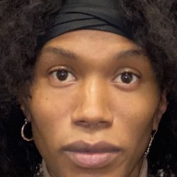 Facial Feminization Before & After Patient #2208