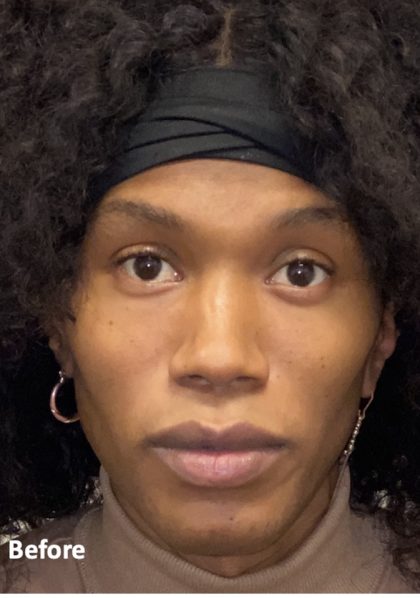 Facial Feminization Before & After Patient #2208
