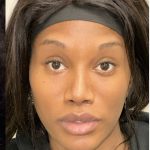 Facial Feminization Before & After Patient #2208
