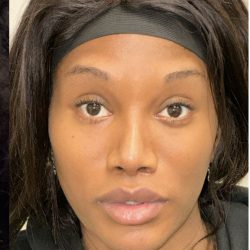 Facial Feminization Before & After Patient #2208