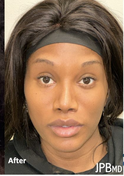 Facial Feminization Before & After Patient #2208