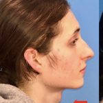 Facial Feminization Before & After Patient #2209
