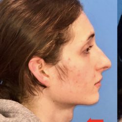 Facial Feminization Before & After Patient #2209