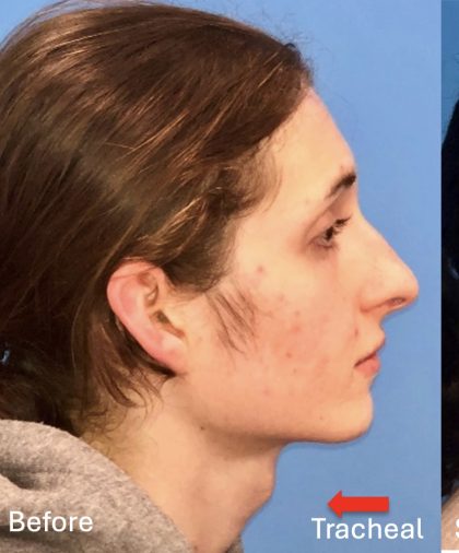 Facial Feminization Before & After Patient #2209