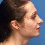 Facial Feminization Before & After Patient #2209