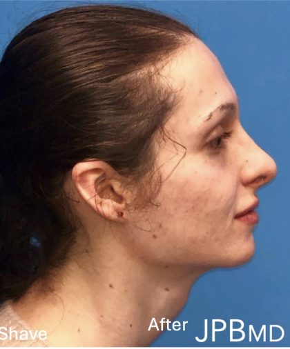 Facial Feminization Before & After Patient #2209