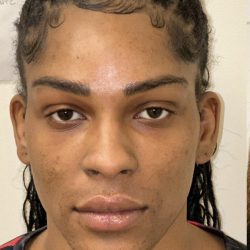 Facial Feminization Before & After Patient #2210