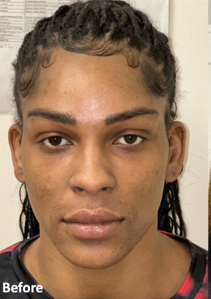 Facial Feminization Before & After Patient #2210