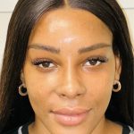 Facial Feminization Before & After Patient #2210