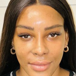 Facial Feminization Before & After Patient #2210