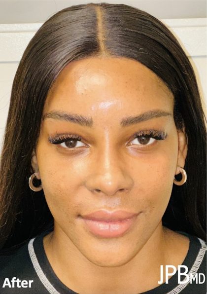 Facial Feminization Before & After Patient #2210